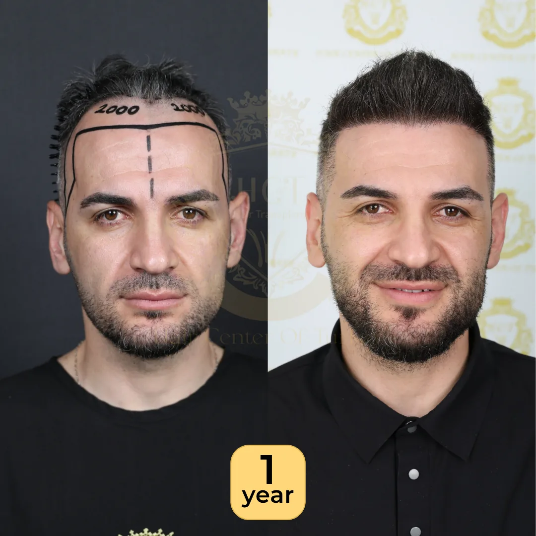 34 года: пересадка 3 750 графтов, техника Sapphire FUE, фото до и через 1 год, Hair Center of Turkey