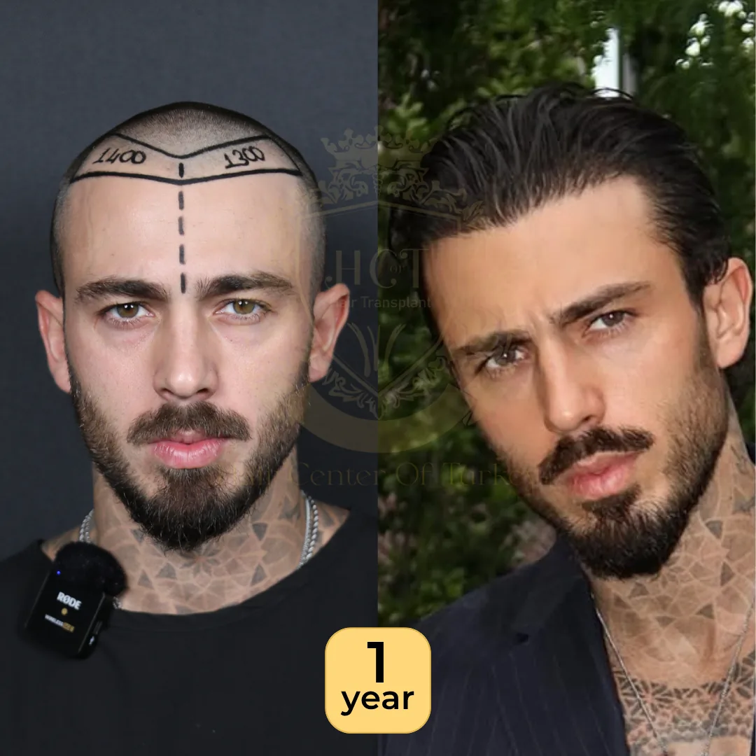 29 лет: пересадка 3 700 графтов, техника Hybrid, фото до и через 1 год, Hair Center of Turkey