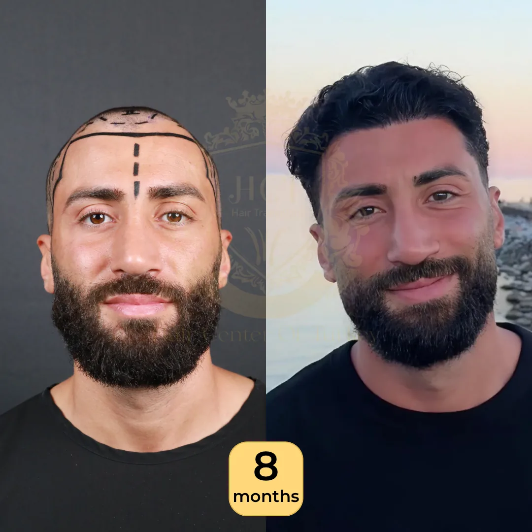30 лет: пересадка 4 200 графтов, техника Sapphire FUE, фото до и через 8 месяцев, Hair Center of Turkey