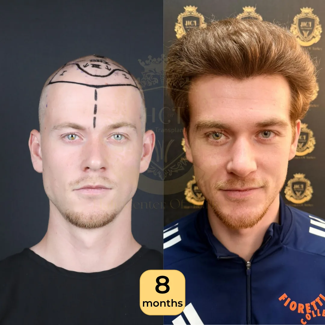 25 лет: пересадка 4 200 графтов, техника Hybrid, фото до и через 8 месяцев, Hair Center of Turkey