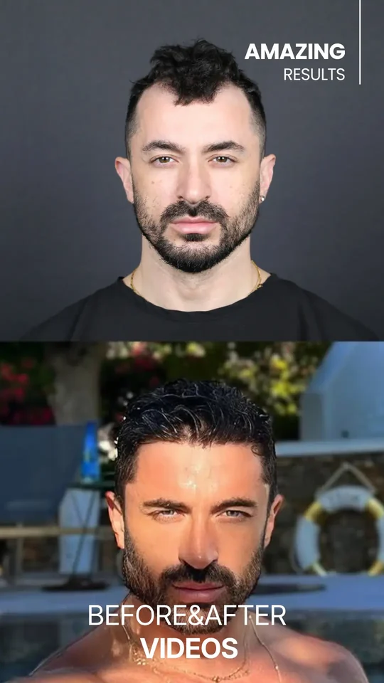 Before & after — результат пересадки волос в Hair Center of Turkey