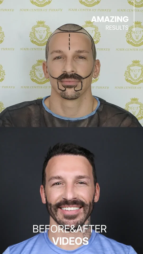 Before & after — результат пересадки волос в Hair Center of Turkey