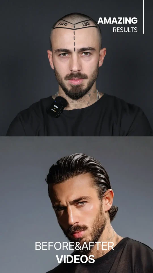 Before & after — результат пересадки волос в Hair Center of Turkey