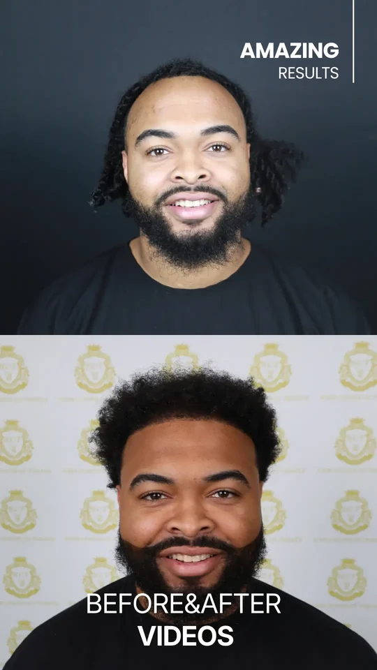 Before & after — результат пересадки волос в Hair Center of Turkey