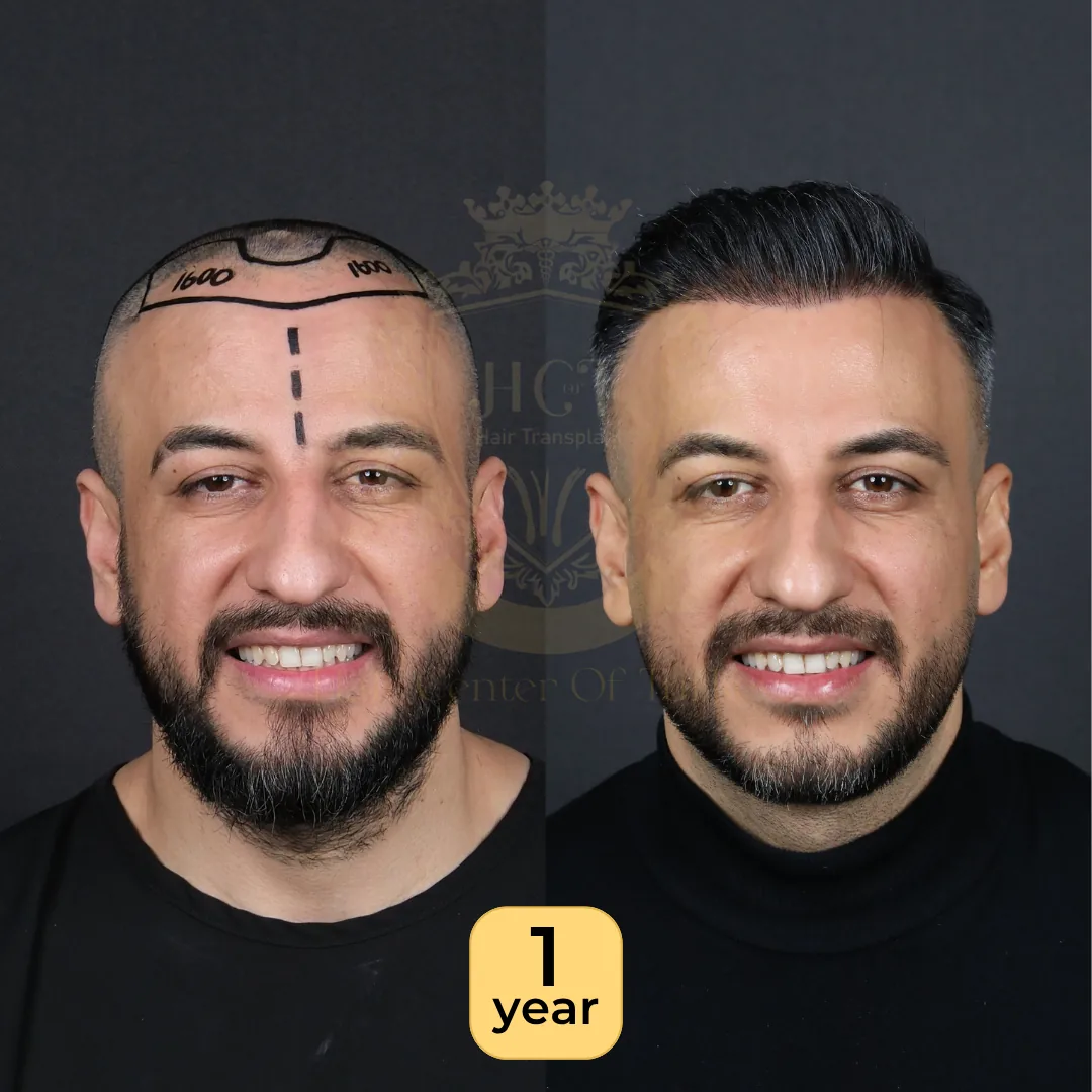 33 года: пересадка 4 000 графтов, техника Sapphire FUE, фото до и через 1 год, Hair Center of Turkey
