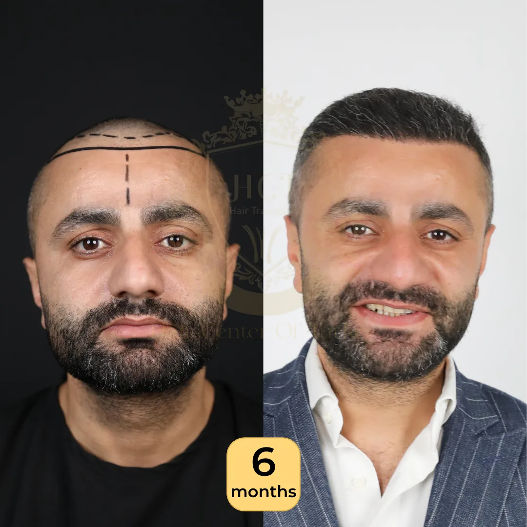32 года: пересадка 2 500 графтов, техника Sapphire FUE, фото до и через 6 месяцев, Hair Center of Turkey