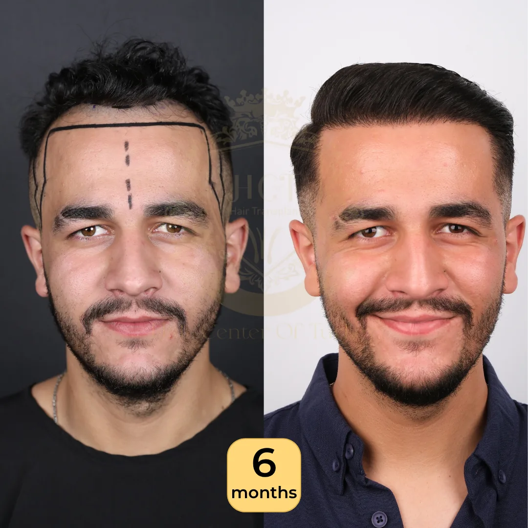 25 лет: пересадка 2 500 графтов, техника Sapphire FUE, фото до и через 6 месяцев, Hair Center of Turkey