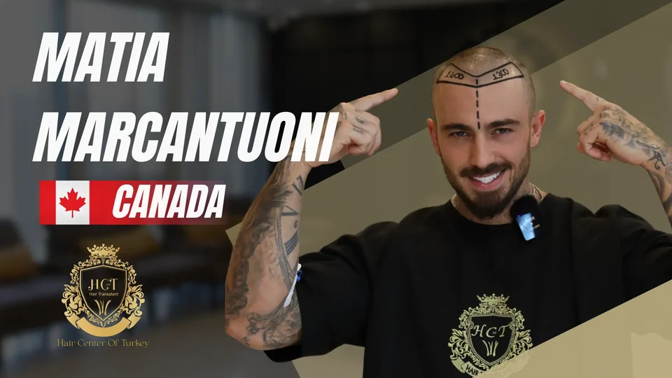 Matia Marcantuoni — опыт пересадки волос в Hair Center of Turkey