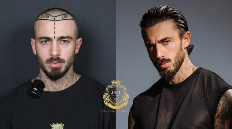 Avant et après une greffe de cheveux FUE