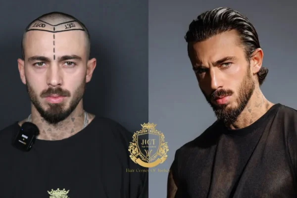 Antes e Depois do Transplante Capilar FUE