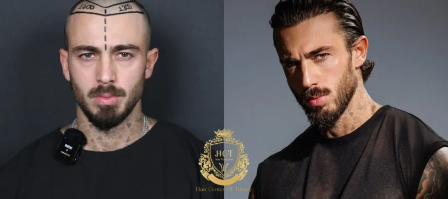 Antes y después del trasplante capilar FUE