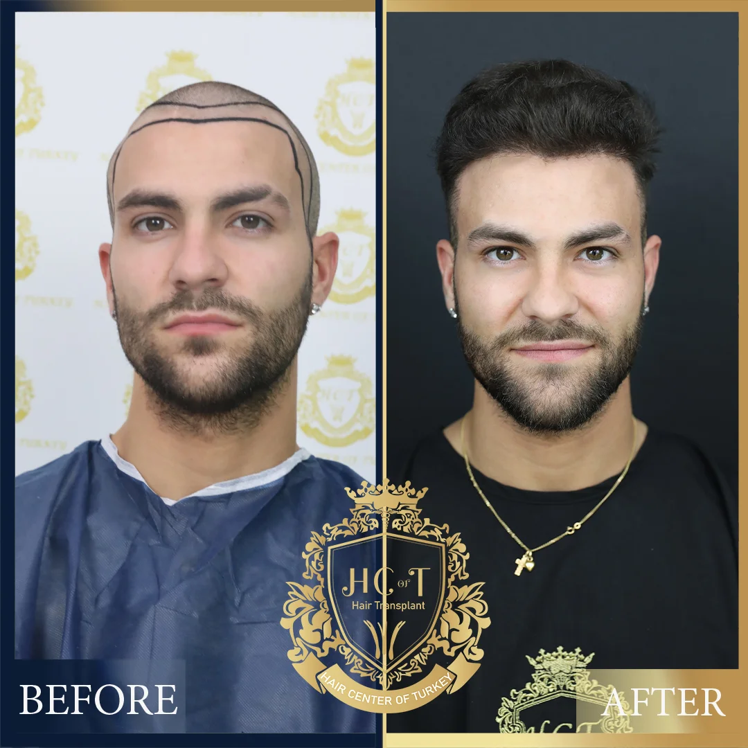 Antes y después del trasplante capilar