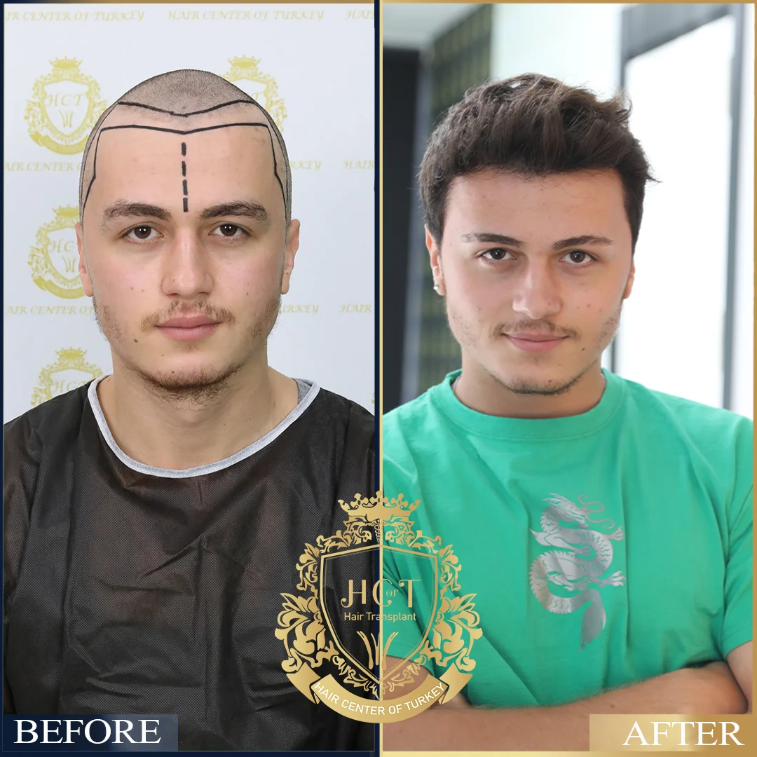 Greffe de cheveux en Turquie avant et après