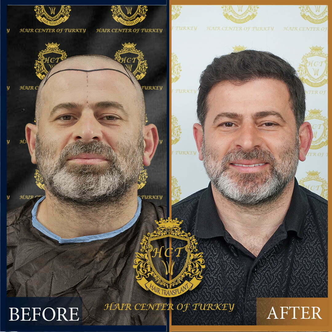 Hair Transplant Turkey before & after