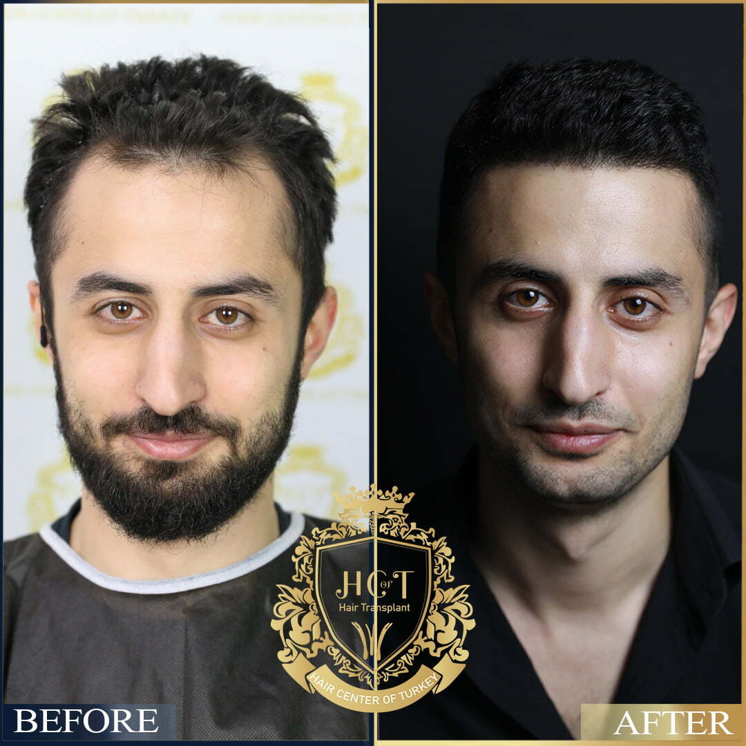 Hair Transplant Turkey Before & After