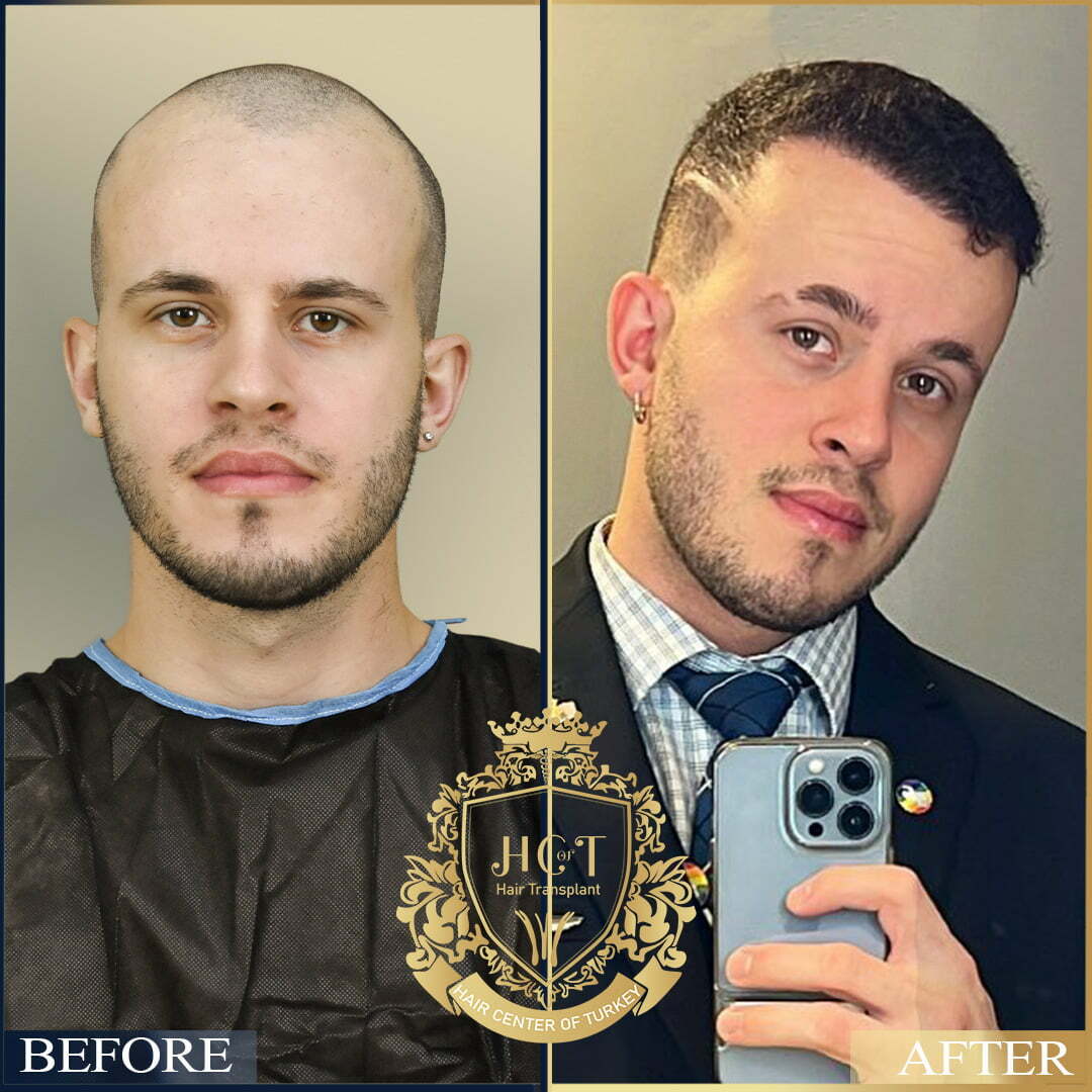 Saç ekimi öncesi ve sonrası