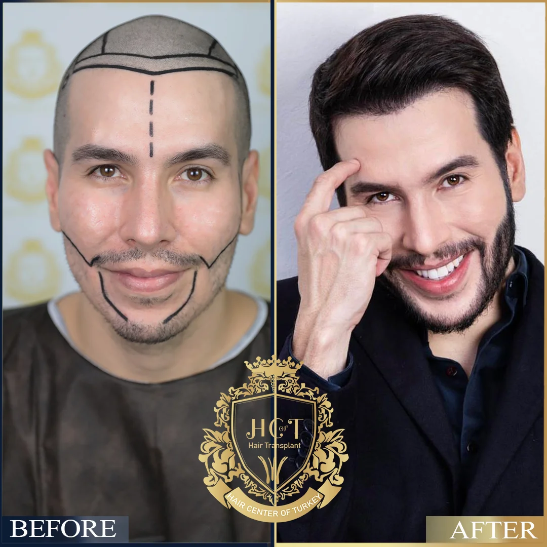 Hair Transplant Turkey Before & After