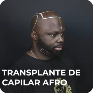 Transplante de Capilar Afro