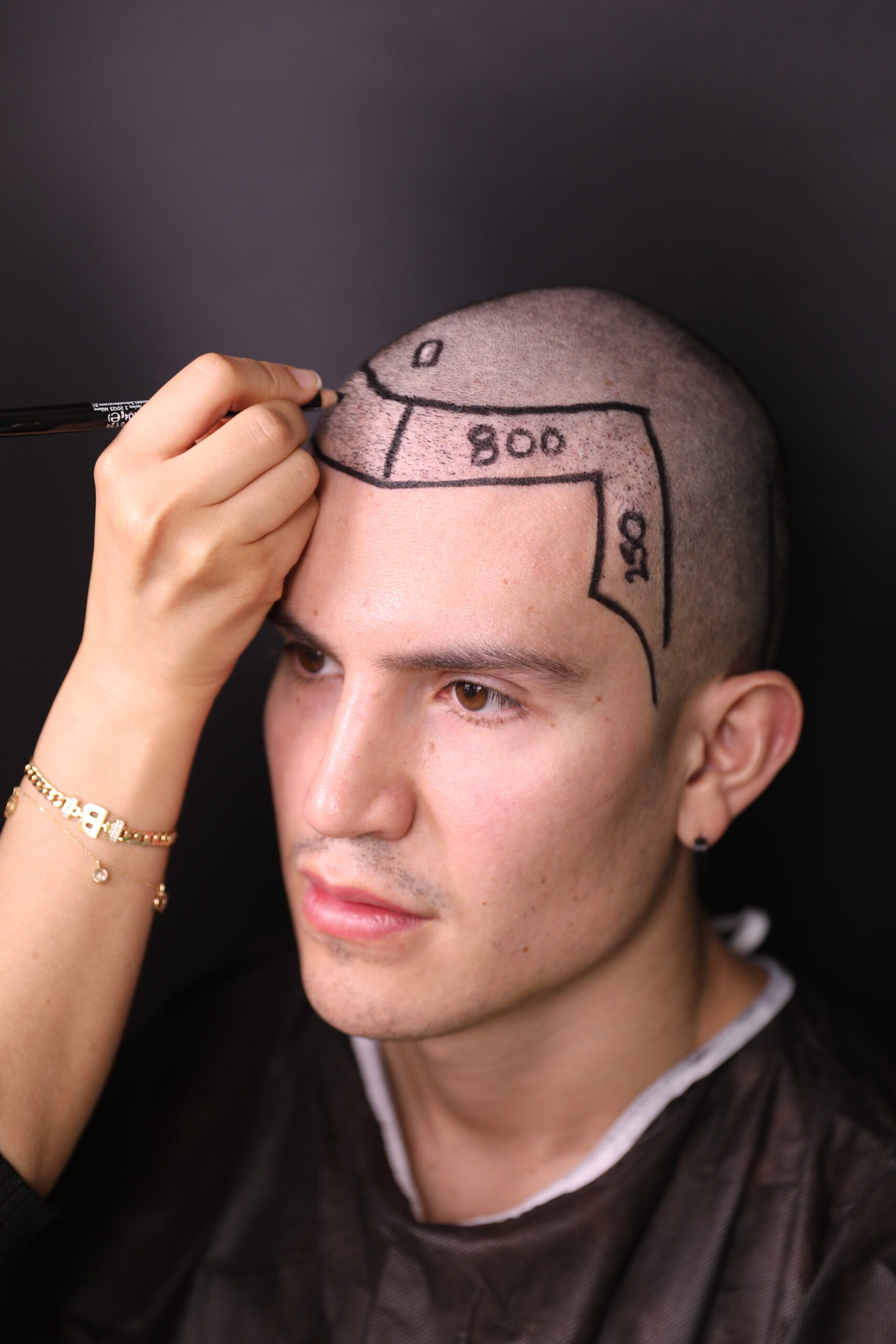 4O3A9722 hair transplant permanent