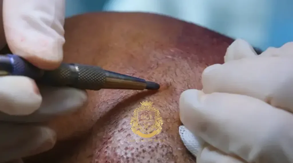 Is it possible to receive a hair transplant from another person?