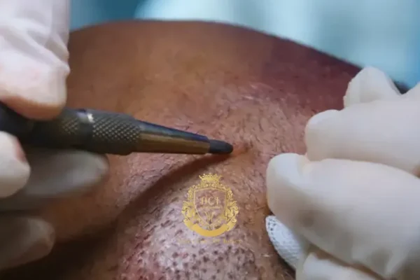 Kann man Haare von einer anderen Person transplantieren lassen?