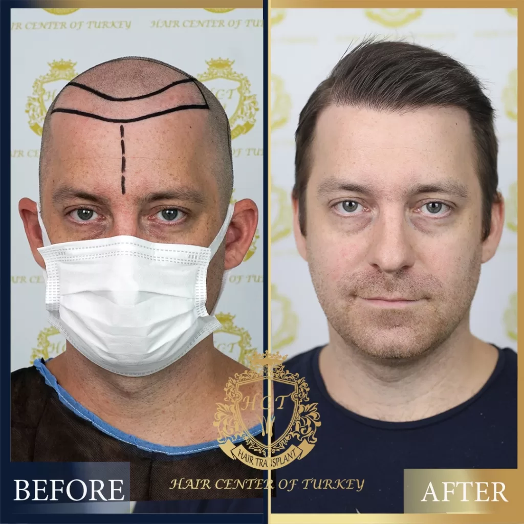 Olivier lalande_Before_After Hair Transplant Before After
