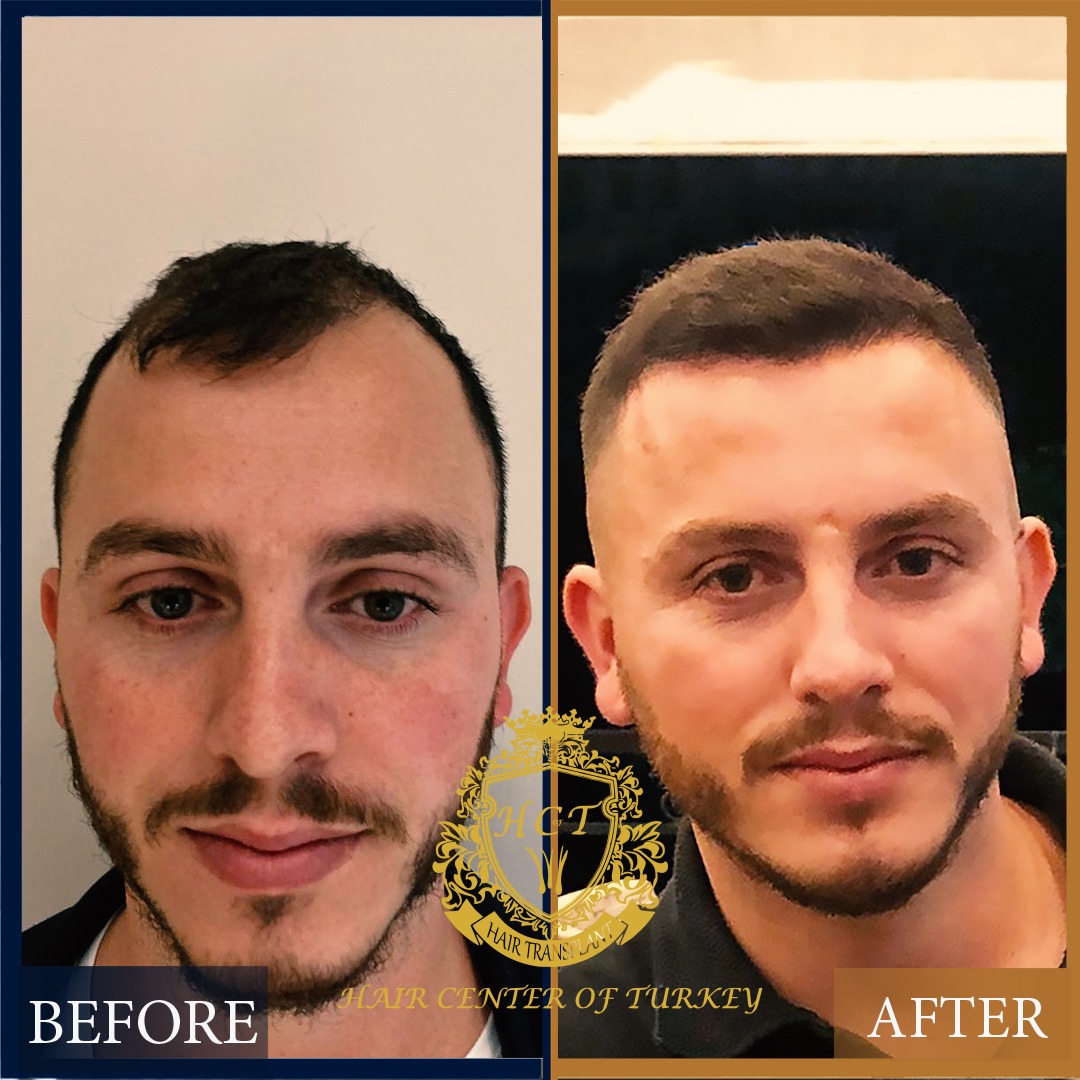 Saç ekimi öncesi ve sonrası