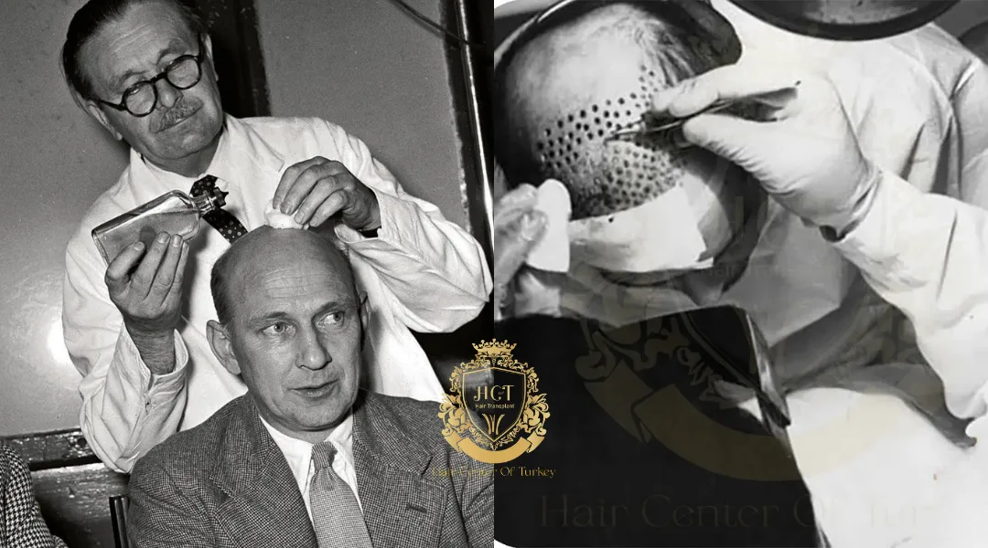 Wer führte die erste Haartransplantation durch? 1 Wer hat die erste Haartransplantation weltweit durchgeführt?