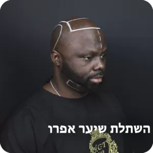 afro hair transplant