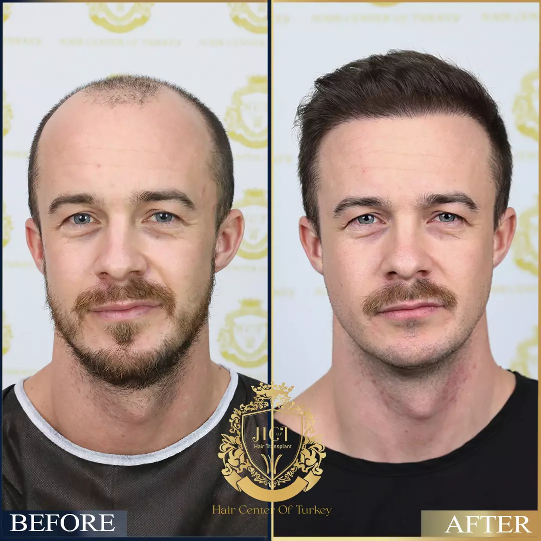 Antes y después del trasplante capilar