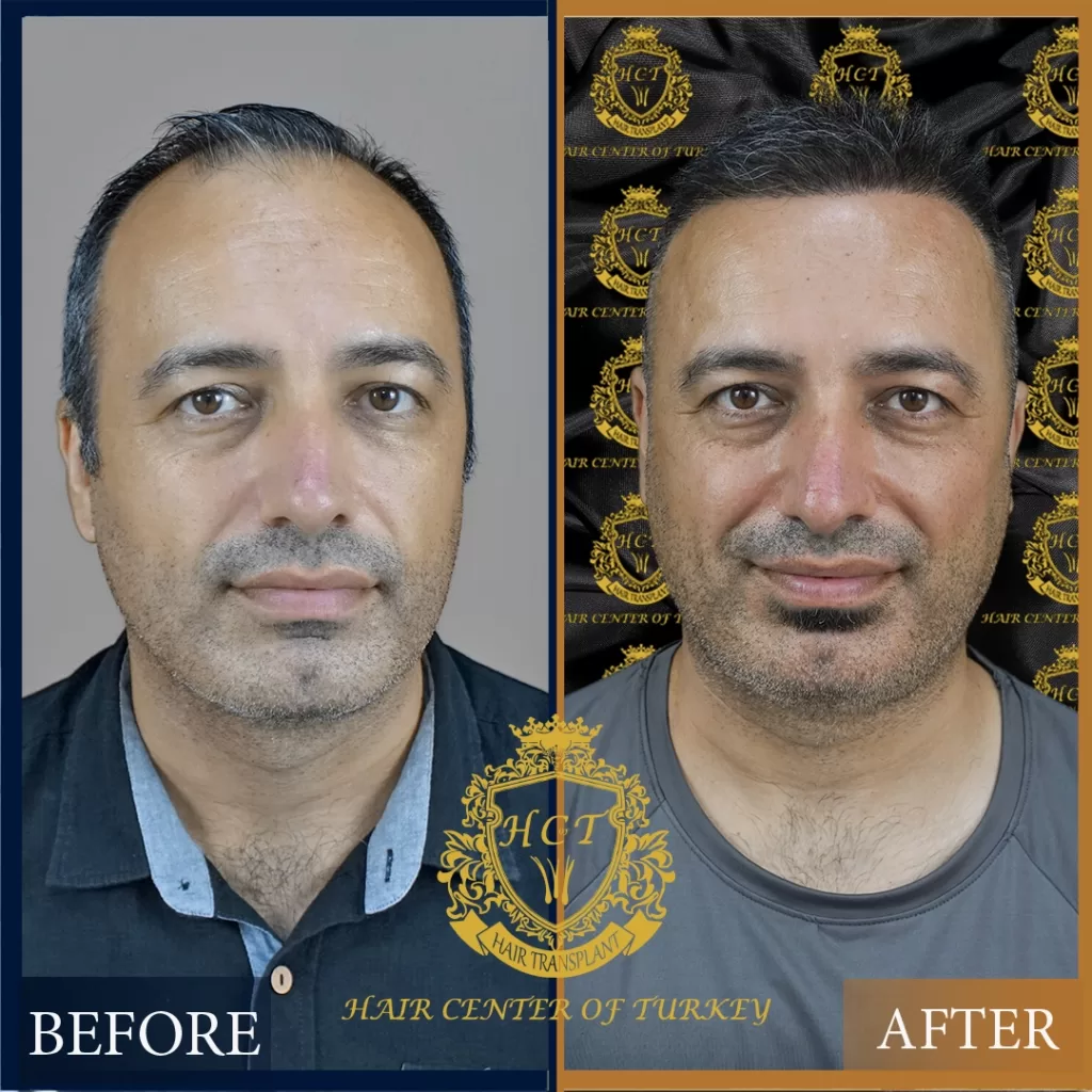 before and after (1) Hair Transplant Before After