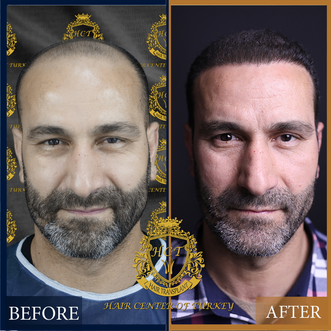 before and after alattin Saç ekimi öncesi ve sonrası