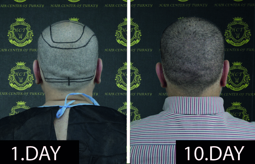 2 Does Donor Hair Grow Back After Hair Transplant?