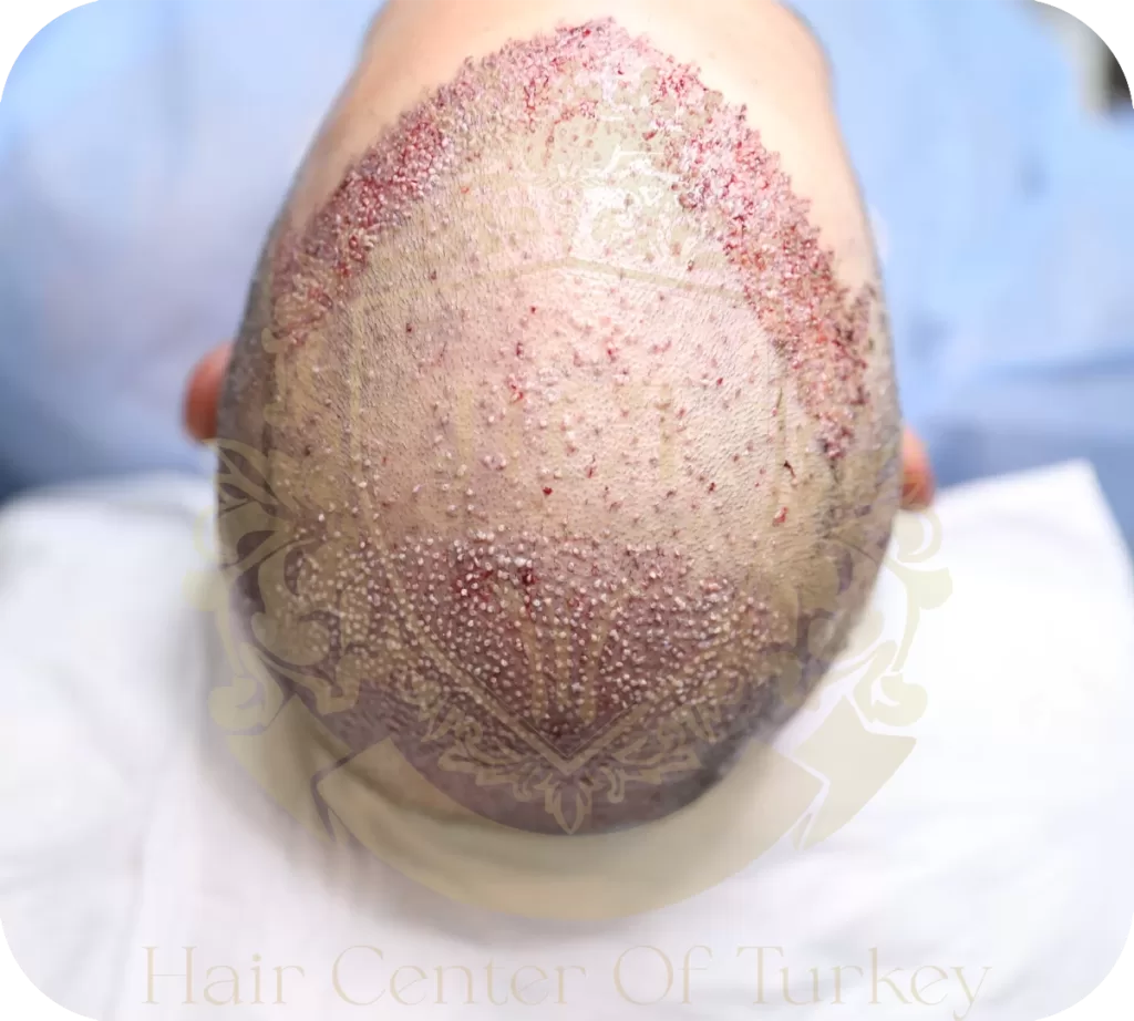 Things To Do After Hair Transplant