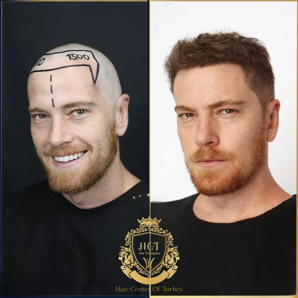 Resultaten haartransplantatie in Turkije