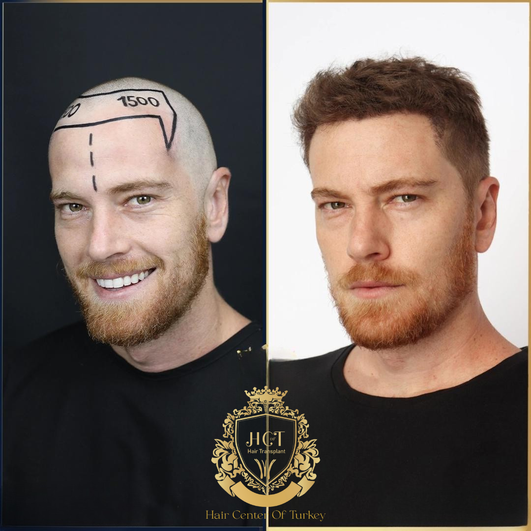 Resultaten haartransplantatie in Turkije