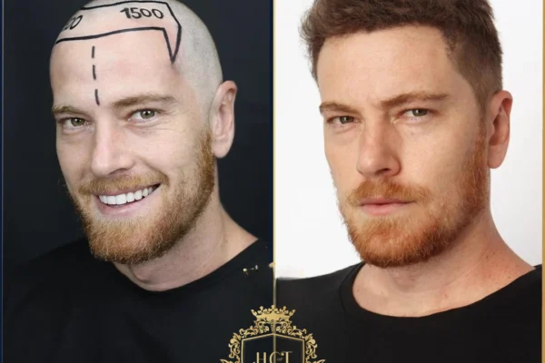 Turkey Hair Transplant Results