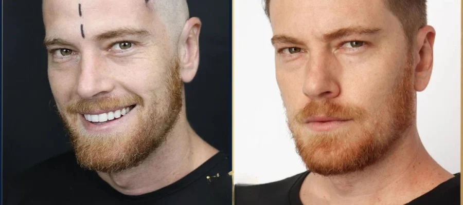 Turkey Hair Transplant Results