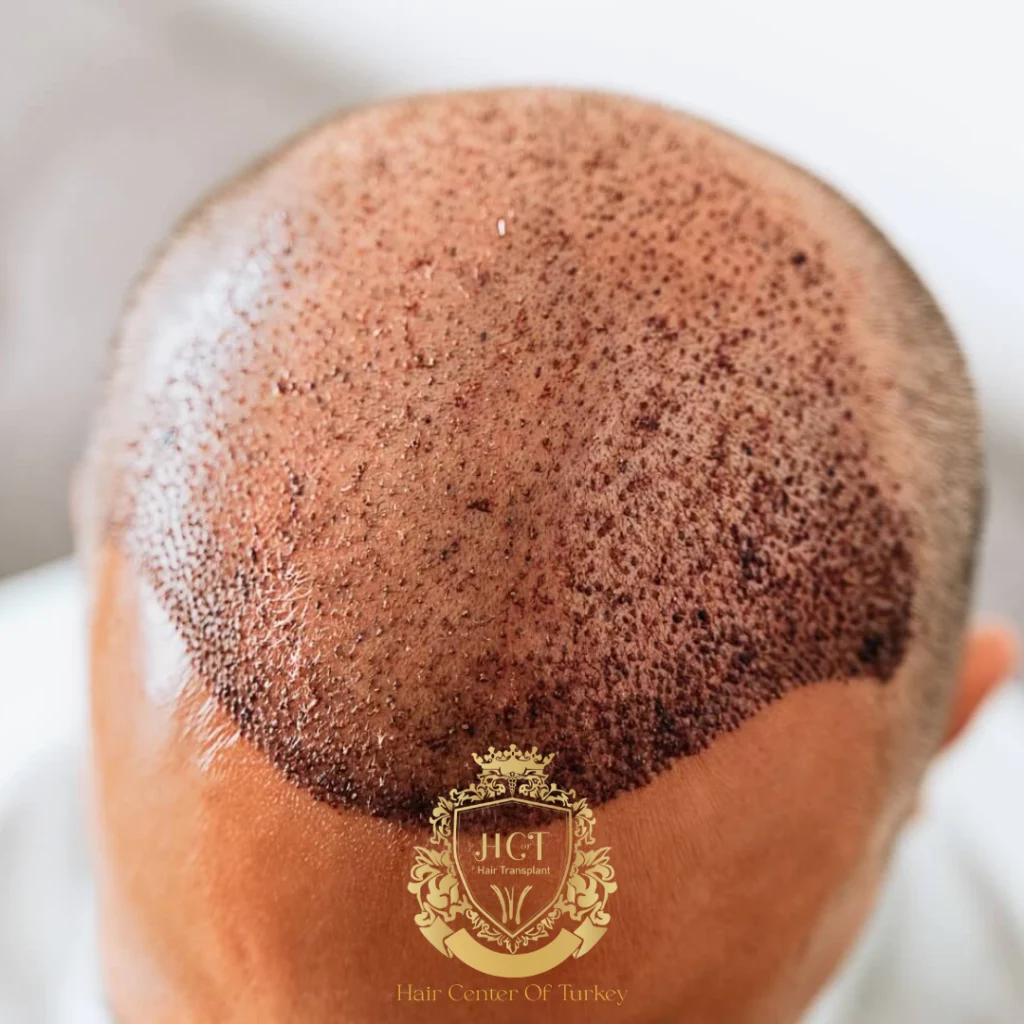 Scalp Necrosis After Hair Transplant