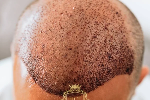 Scalp Necrosis After Hair Transplant