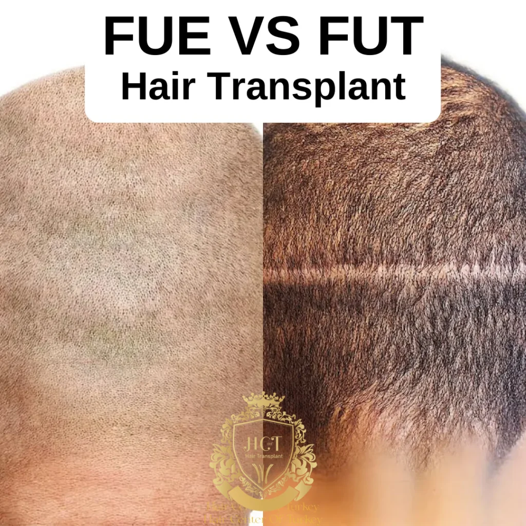 What Is The Difference Between FUE vs FUT Hair Transplant Methods?