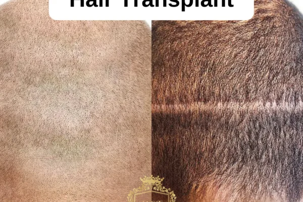 What is the Difference between FUE vs FUT Hair Transplant Methods?