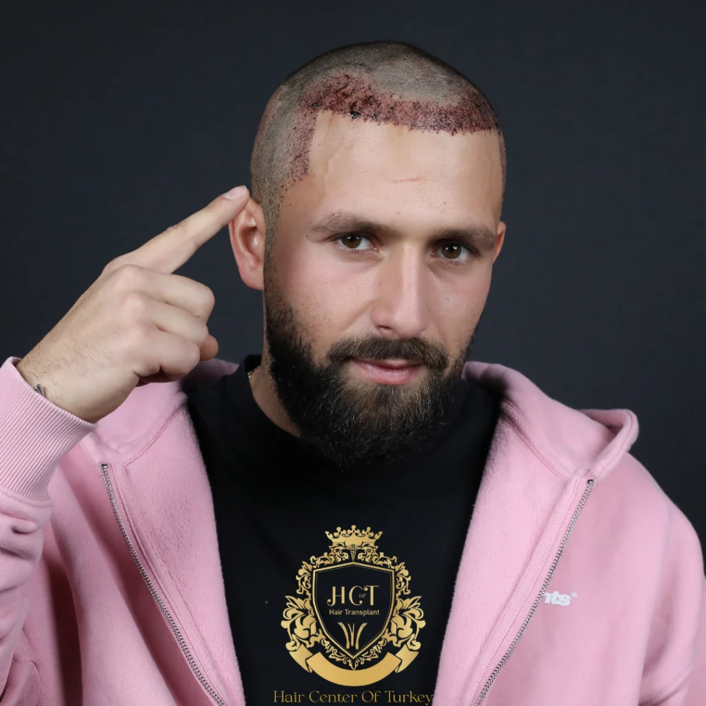 Is Hair Transplant Halal Or Haram In Islam?