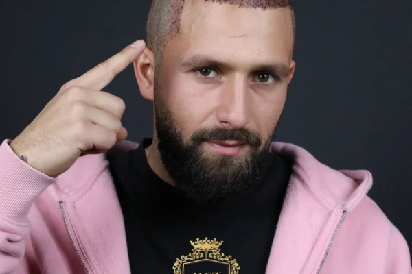 Is hair transplant halal or haram in Islam?