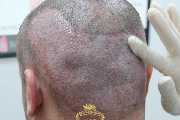 Hair Transplant Side Effects