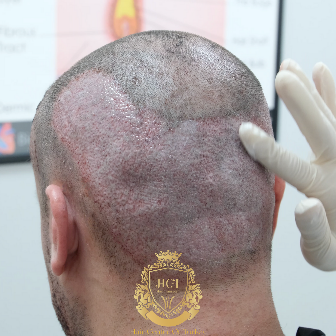 Nebenwirkungen einer Haartransplantation