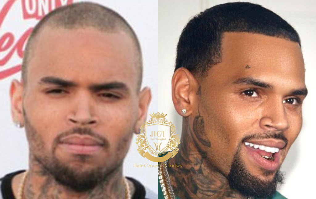Chris Brown Hair Transplant Before and After