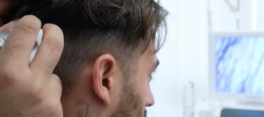 Haaruitval bij mannen