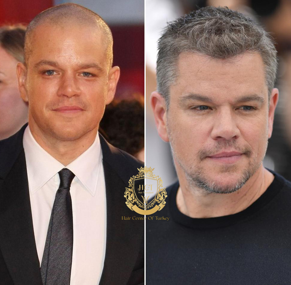 Matt Damon hair Transplant