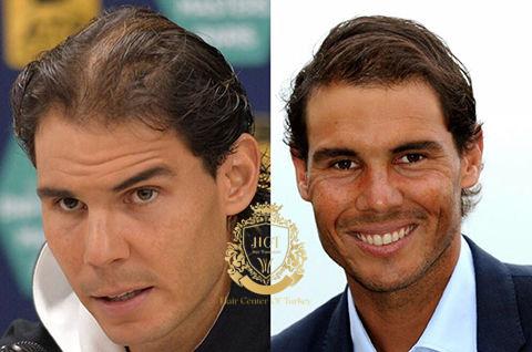 Rafael Nadal hair Transplant
